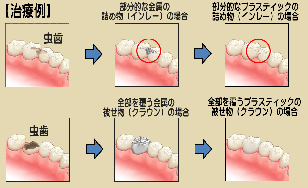 虫歯の治療例